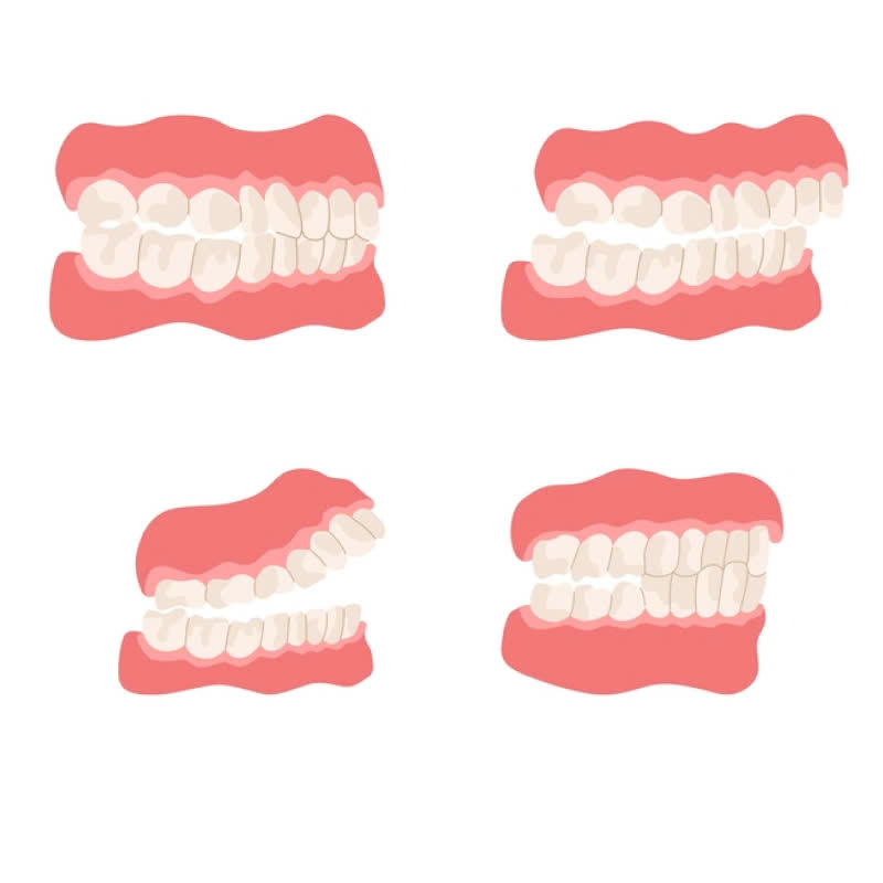 nieng-rang-bang-mac-cai-kim-loai-tu-khoa-la-gi-co-hieu-qua-nhu-nieng-rang-bang-mac-cai-truyen-thong