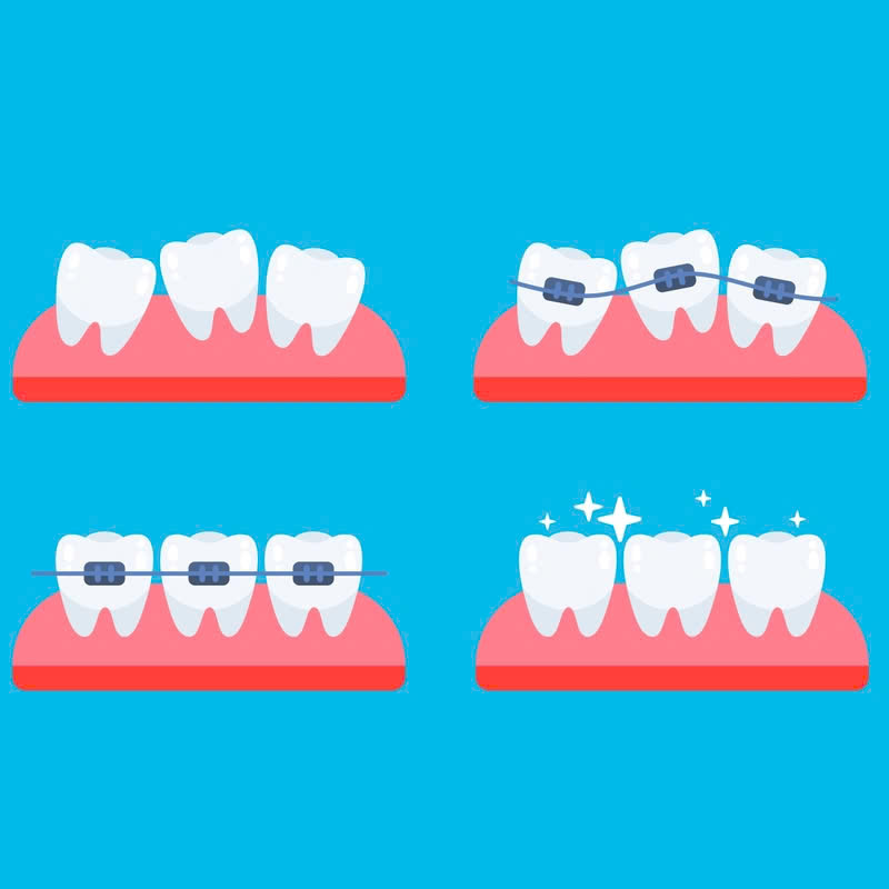 nieng-rang-bang-mac-cai-kim-loai-tu-khoa-la-gi-co-hieu-qua-nhu-nieng-rang-bang-mac-cai-truyen-thong