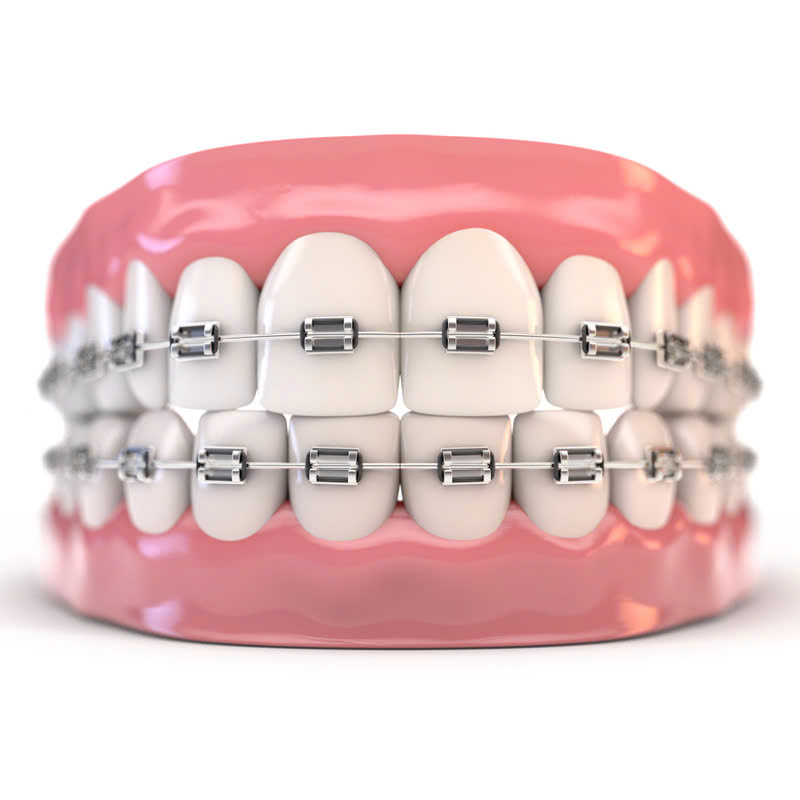 nieng-rang-bang-mac-cai-kim-loai-tu-khoa-la-gi-co-hieu-qua-nhu-nieng-rang-bang-mac-cai-truyen-thong