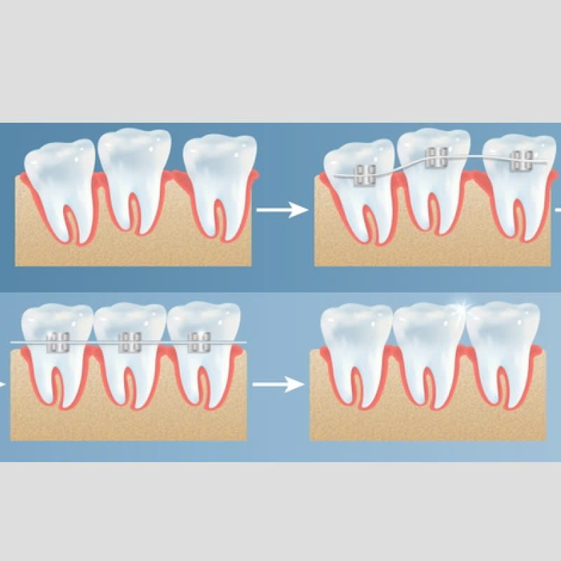 nieng-rang-bang-mac-cai-kim-loai-tu-khoa-la-gi-co-hieu-qua-nhu-nieng-rang-bang-mac-cai-truyen-thong
