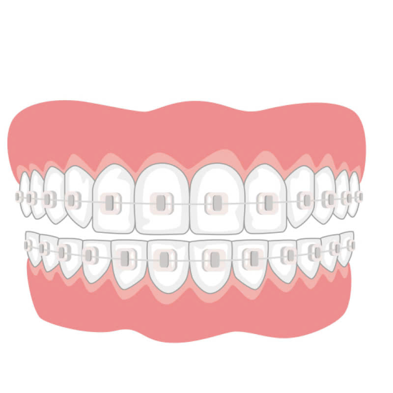 nieng-rang-bang-mac-cai-su-la-gi-nhung-dieu-can-biet-truoc-khi-dieu-chinh-khuyet-diem-ham-rang