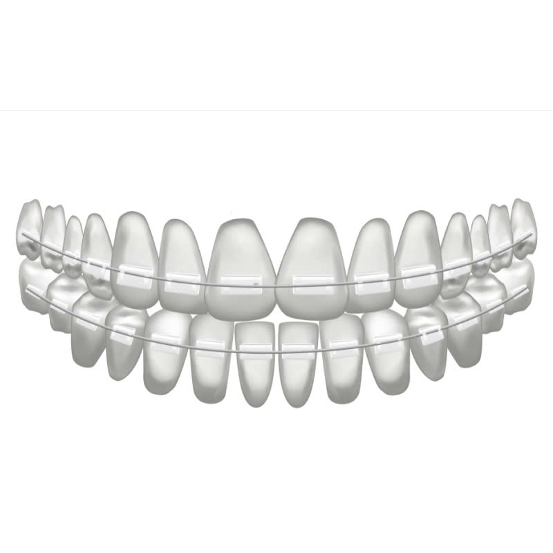 nieng-rang-bang-mac-cai-su-la-gi-nhung-dieu-can-biet-truoc-khi-dieu-chinh-khuyet-diem-ham-rang