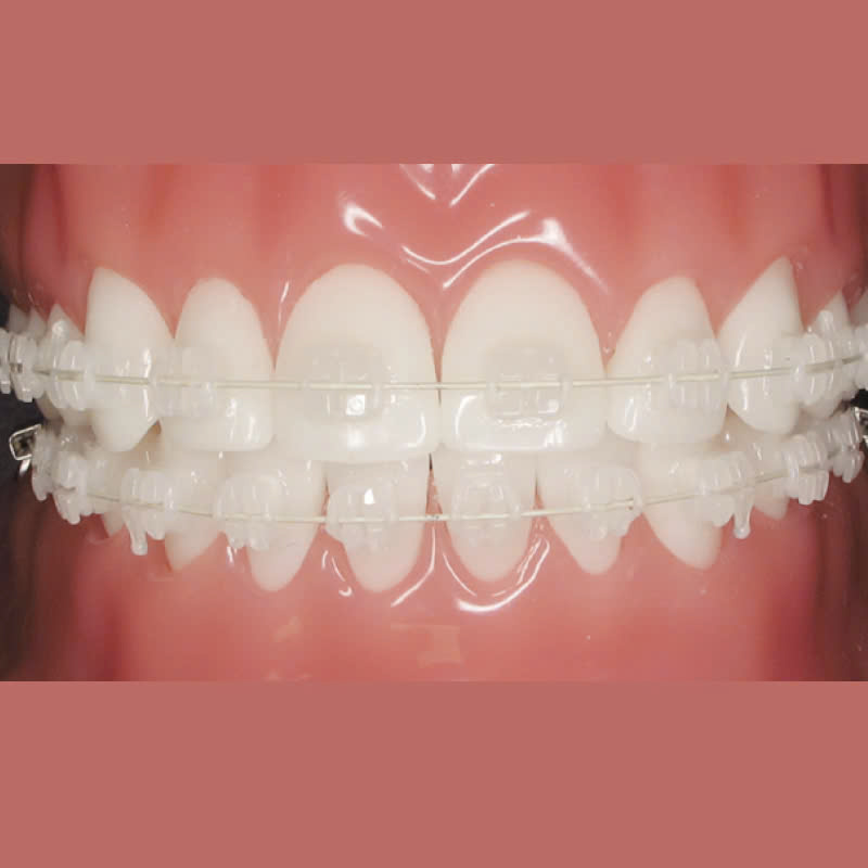 nieng-rang-bang-mac-cai-su-tu-khoa-giai-phap-tham-my-cho-ham-rang-hoan-hao-deu-dep-khong-gay-com-hay-kho-chiu