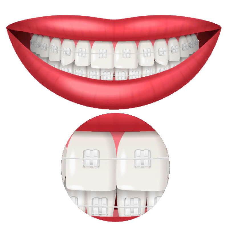 nieng-rang-bang-mac-cai-su-tu-khoa-giai-phap-tham-my-cho-ham-rang-hoan-hao-deu-dep-khong-gay-com-hay-kho-chiu