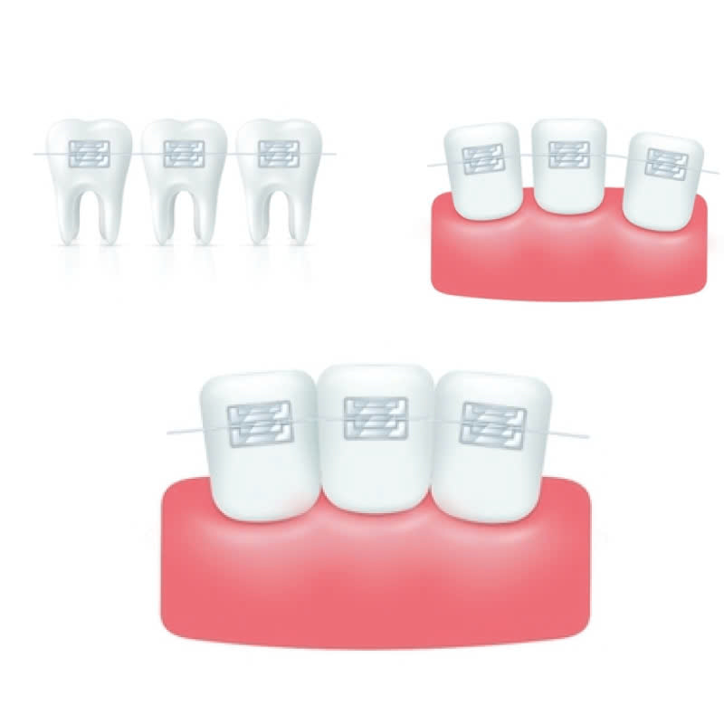 nieng-rang-bang-mac-cai-su-tu-khoa-giai-phap-tham-my-cho-ham-rang-hoan-hao-deu-dep-khong-gay-com-hay-kho-chiu