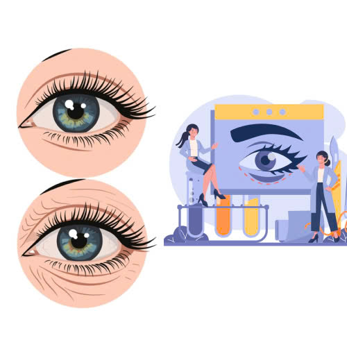 vi-sao-nen-chon-phau-thuat-cay-mo-mat-an-toan-ai-nen-va-khong-nen-thuc-hien-phuong-phap-lam-dep-nay