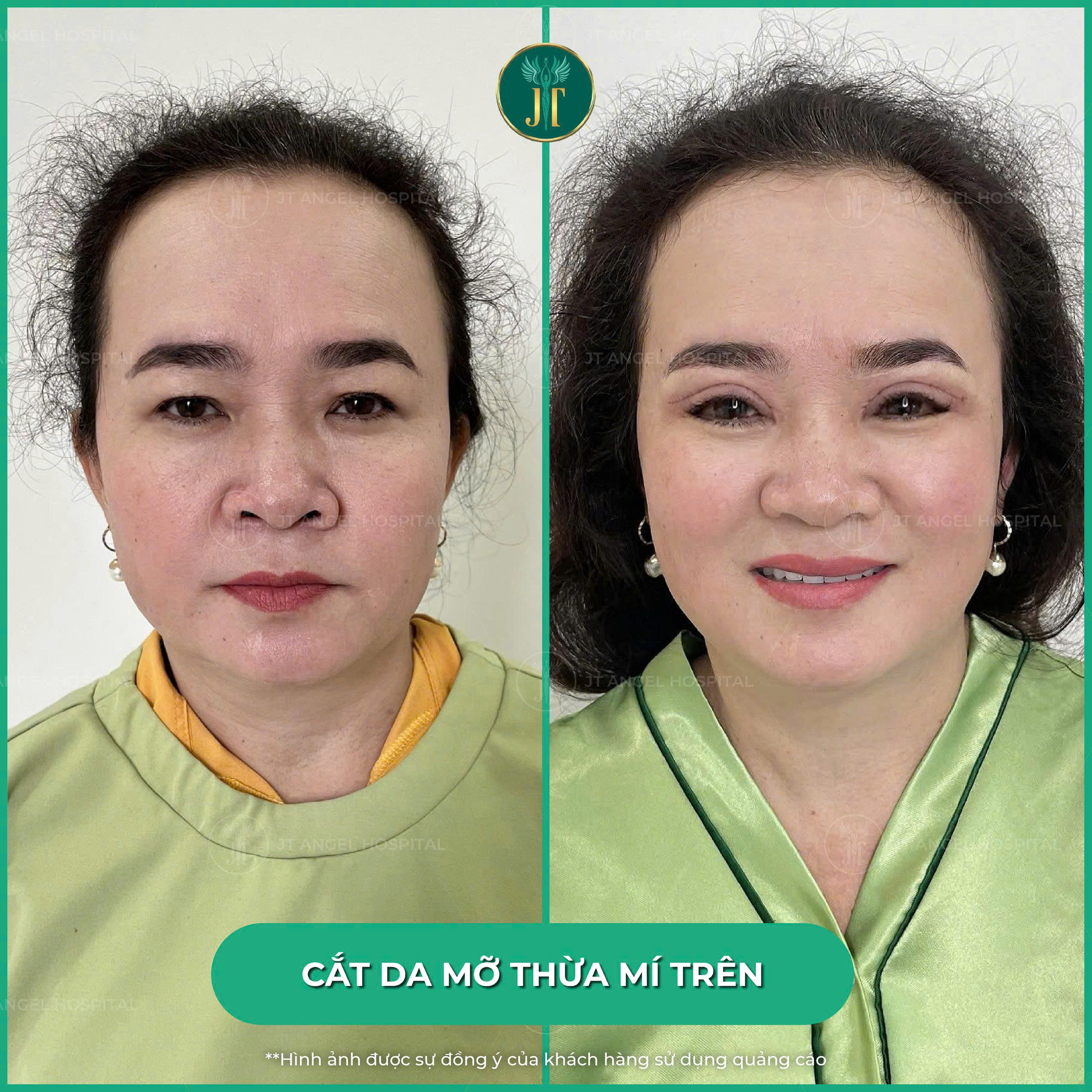 phau-thuat-lay-mo-mi-tren-an-toan-la-gi-cung-tim-hieu-nhung-dieu-luu-y-quan-trong-truoc-khi-thuc-hien-de-tranh-rui-ro
