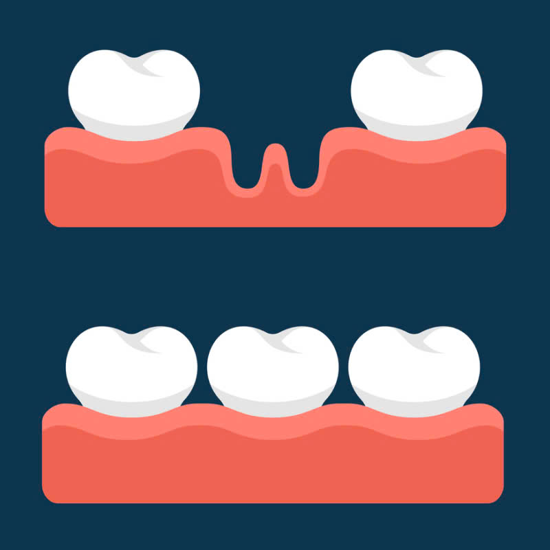 loi-ich-cua-phuc-hinh-su-cercon-tu-ben-dep-den-tu-nhien