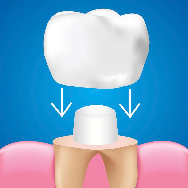 loi-ich-cua-phuc-hinh-su-cercon-tu-ben-dep-den-tu-nhien