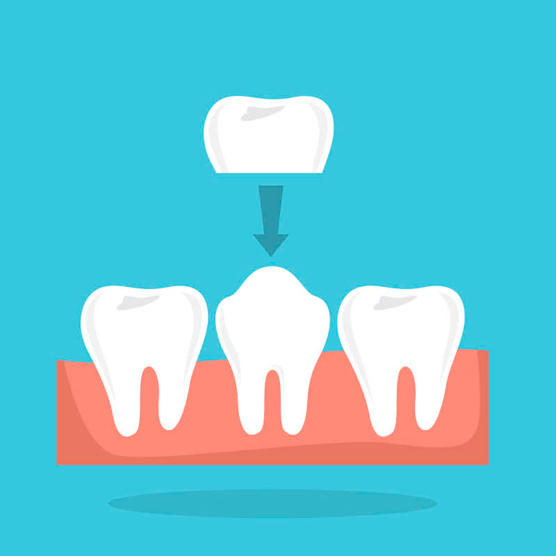 rang-su-lava-plus-la-gi-nhung-doi-tuong-nao-phu-hop-voi-loai-rang-su-nay