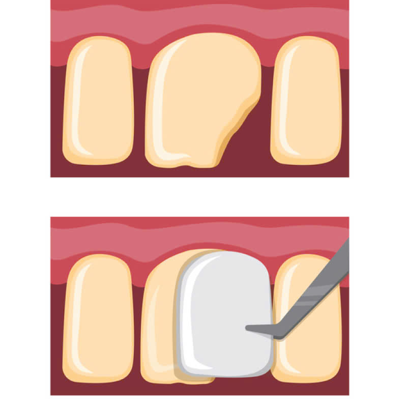 rang-su-lava-plus-la-gi-nhung-doi-tuong-nao-phu-hop-voi-loai-rang-su-nay