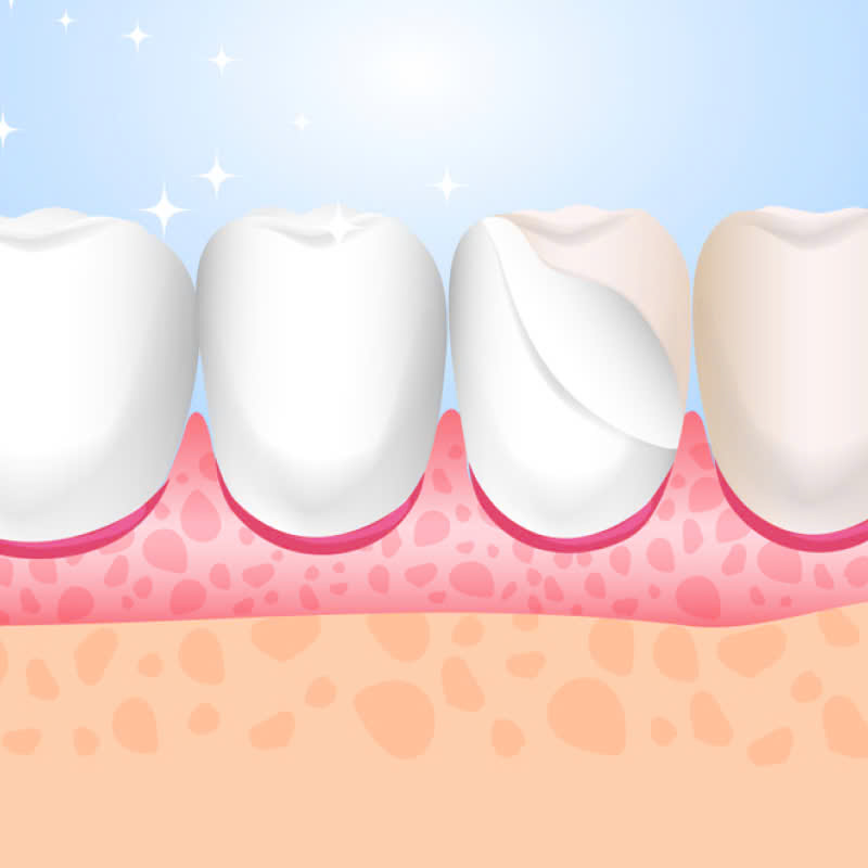 cung-tim-hieu-ve-rang-su-orodent-bleach-va-nhung-luu-y-khi-thuc-hien-dich-vu