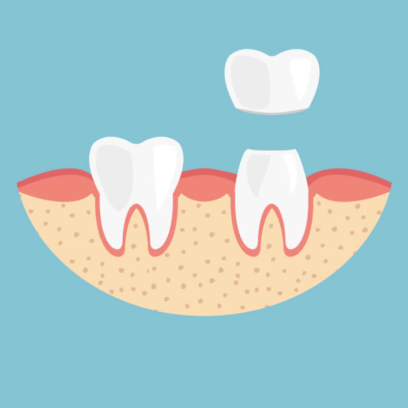 tai-sao-rang-su-y-la-lua-chon-hang-dau-cho-nguoi-muon-cai-thien-nu-cuoi