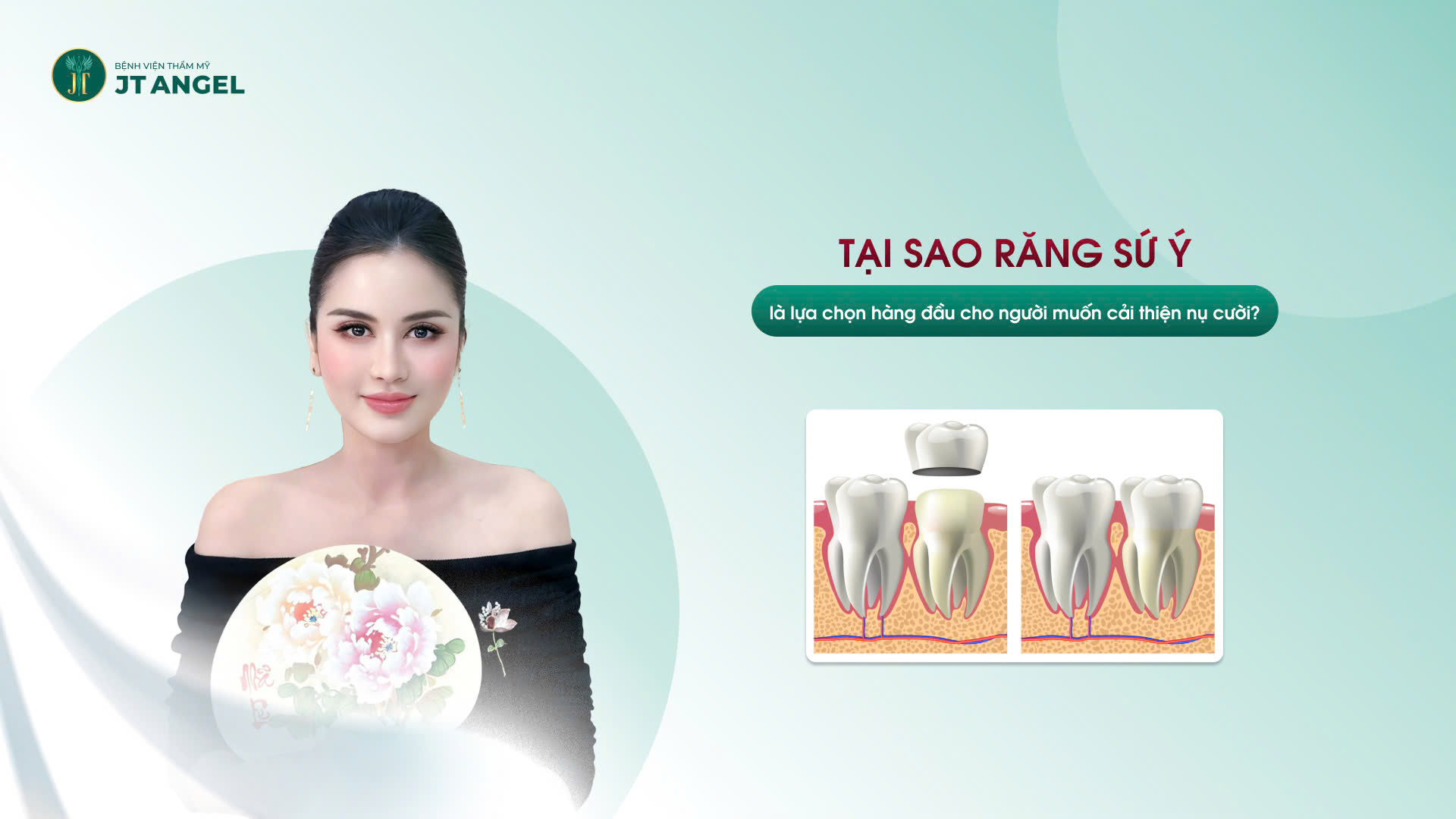 tai-sao-rang-su-y-la-lua-chon-hang-dau-cho-nguoi-muon-cai-thien-nu-cuoi