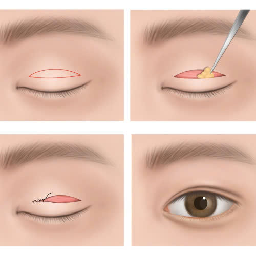 review-lay-mo-mi-tren-chia-se-thuc-te-va-kinh-nghiem-giup-doi-mat-tre-dep-tu-nhien