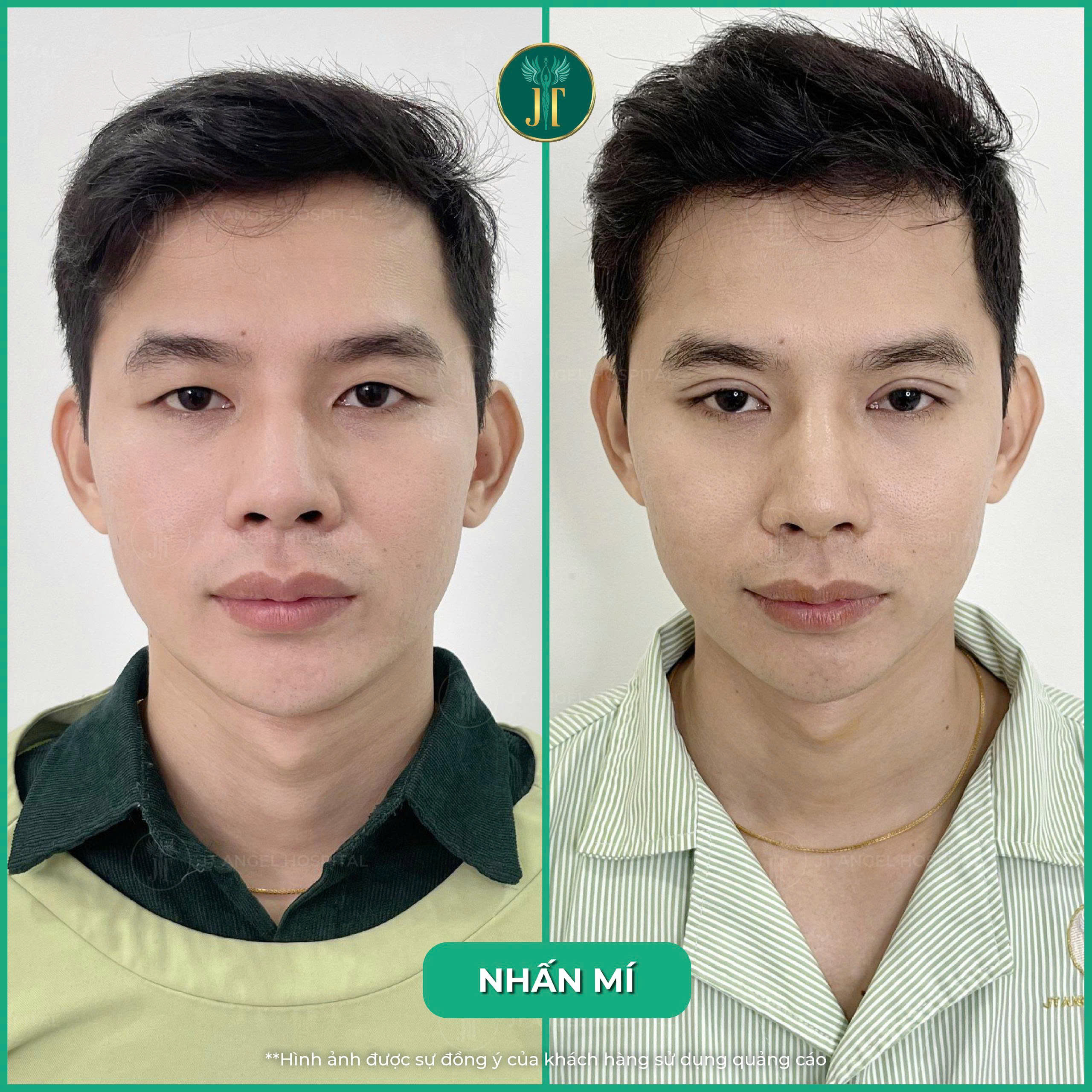 review-nhan-mi-trai-nghiem-that-ket-qua-that-tu-goc-nhin-khach-hang-giup-ban-hieu-ro-truoc-khi-lam-dep