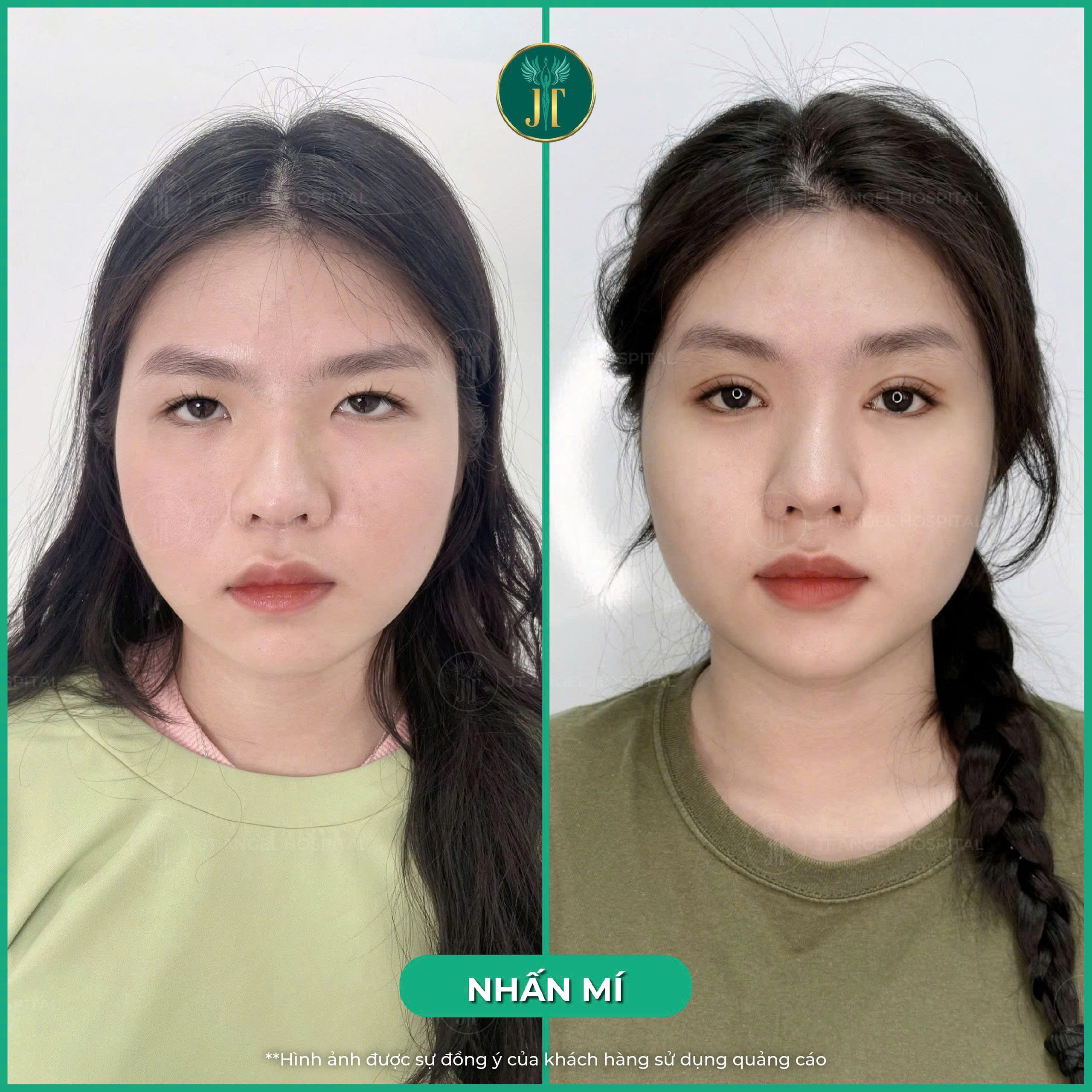 review-nhan-mi-trai-nghiem-that-ket-qua-that-tu-goc-nhin-khach-hang-giup-ban-hieu-ro-truoc-khi-lam-dep