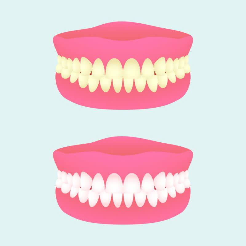 tay-trang-rang-loai-bo-hoan-toan-vet-o-vang-den-sam-tra-lai-nu-cuoi-trang-sang-tu-nhien