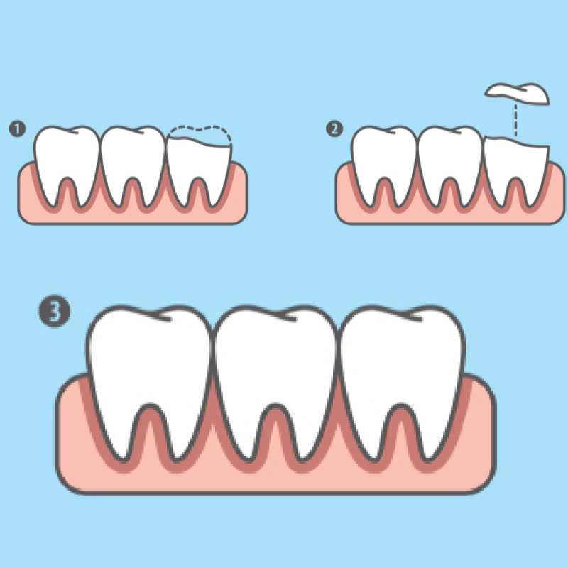 tram-rang-giai-phap-hoan-hao-cho-ham-rang-chac-khoe-tu-tin-sau-rang-nho-khong-dang-lo