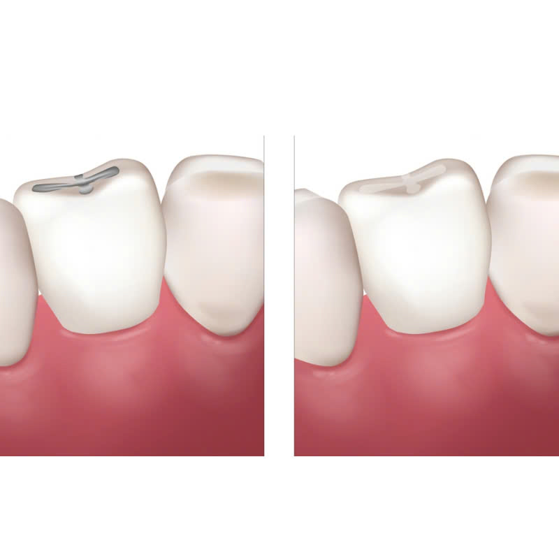 tram-rang-giai-phap-hoan-hao-cho-ham-rang-chac-khoe-tu-tin-sau-rang-nho-khong-dang-lo