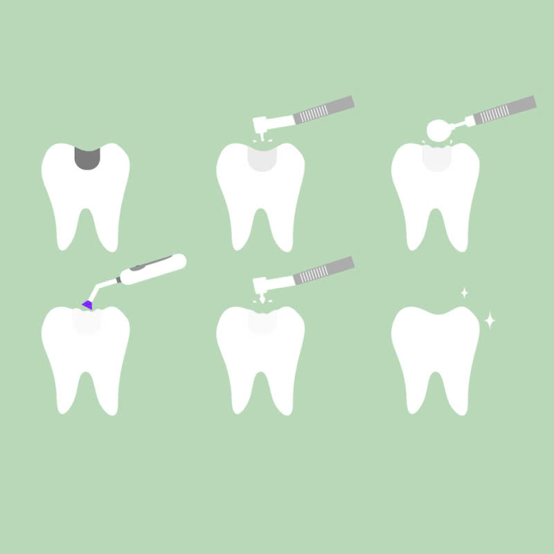 tram-rang-giai-phap-hoan-hao-cho-ham-rang-chac-khoe-tu-tin-sau-rang-nho-khong-dang-lo