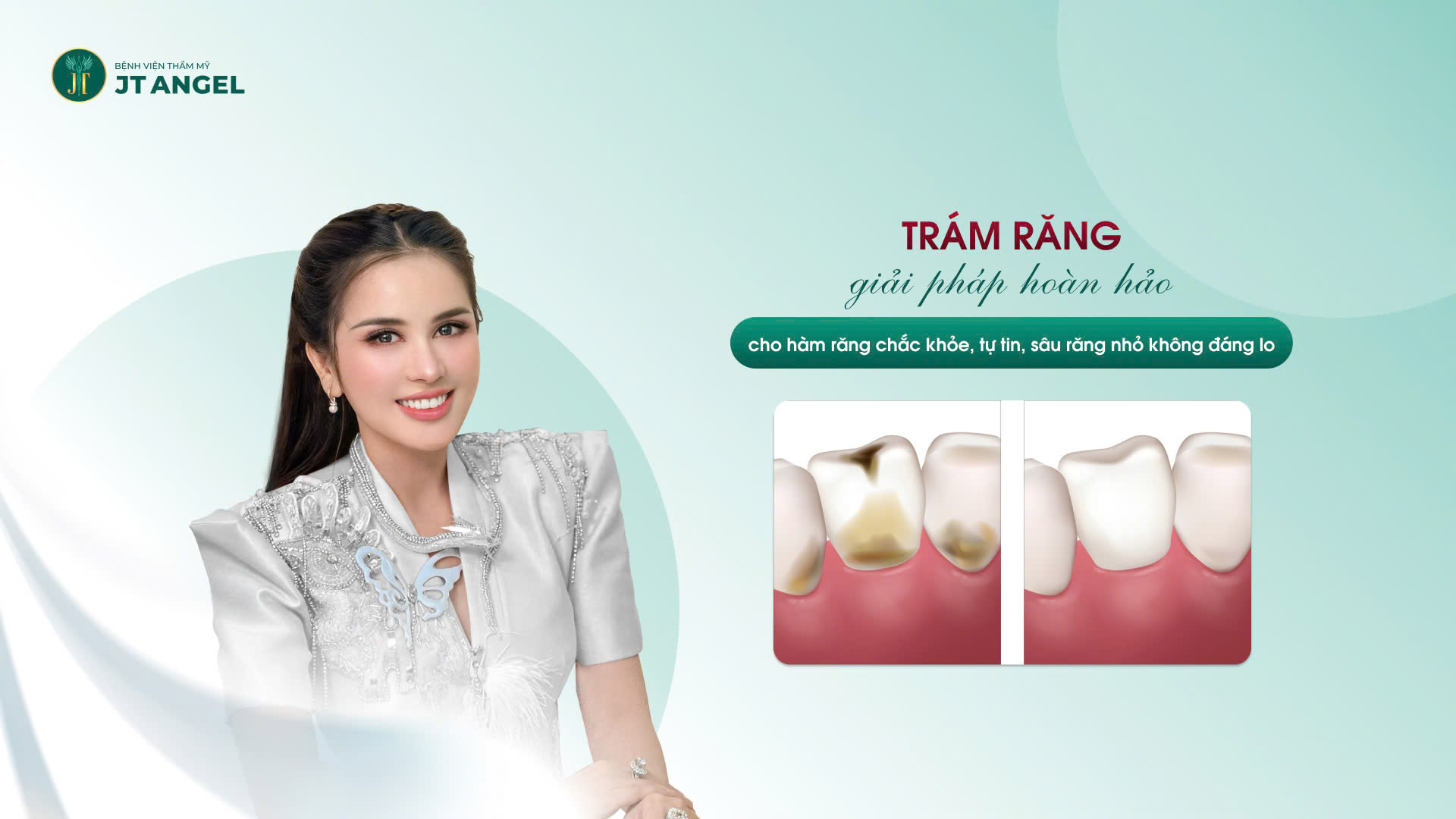 tram-rang-giai-phap-hoan-hao-cho-ham-rang-chac-khoe-tu-tin-sau-rang-nho-khong-dang-lo