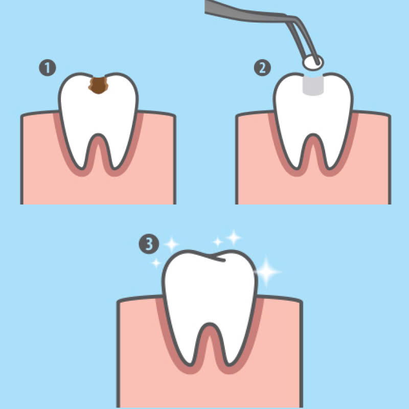 tram-rang-giai-phap-hoan-hao-cho-ham-rang-chac-khoe-tu-tin-sau-rang-nho-khong-dang-lo
