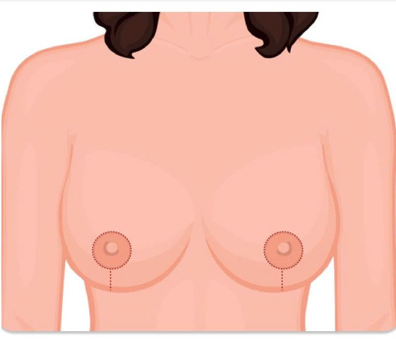 treo-sa-tre-nguc-muc-do-nhe-la-gi-khi-nao-nen-thuc-hien-de-giu-dang-nguc-dep-tu-nhien