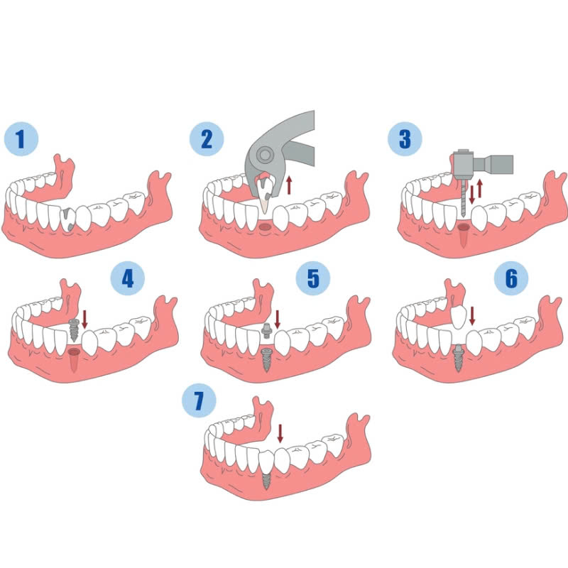 trong-rang-implant-khac-phuc-noi-lo-mat-rang-hieu-qua-dam-bao-chuc-nang-an-nhai-va-giu-duoc-tham-my-nu-cuoi