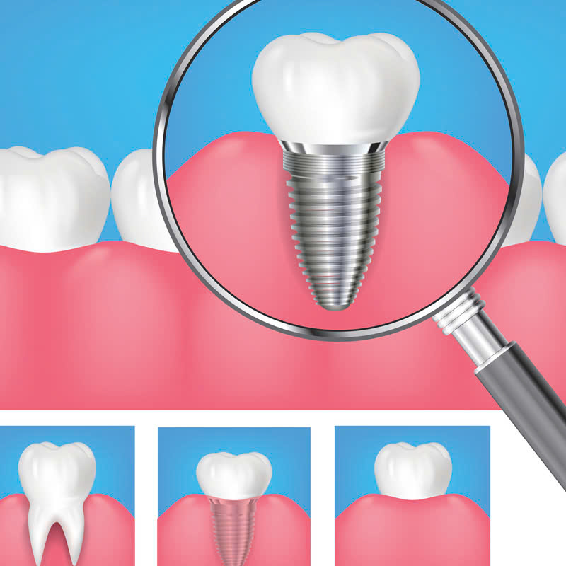 trong-rang-implant-khac-phuc-noi-lo-mat-rang-hieu-qua-dam-bao-chuc-nang-an-nhai-va-giu-duoc-tham-my-nu-cuoi