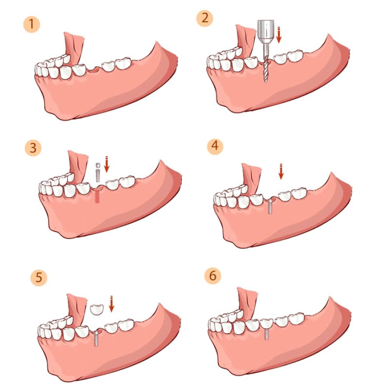 trong-rang-implant-khac-phuc-noi-lo-mat-rang-hieu-qua-dam-bao-chuc-nang-an-nhai-va-giu-duoc-tham-my-nu-cuoi