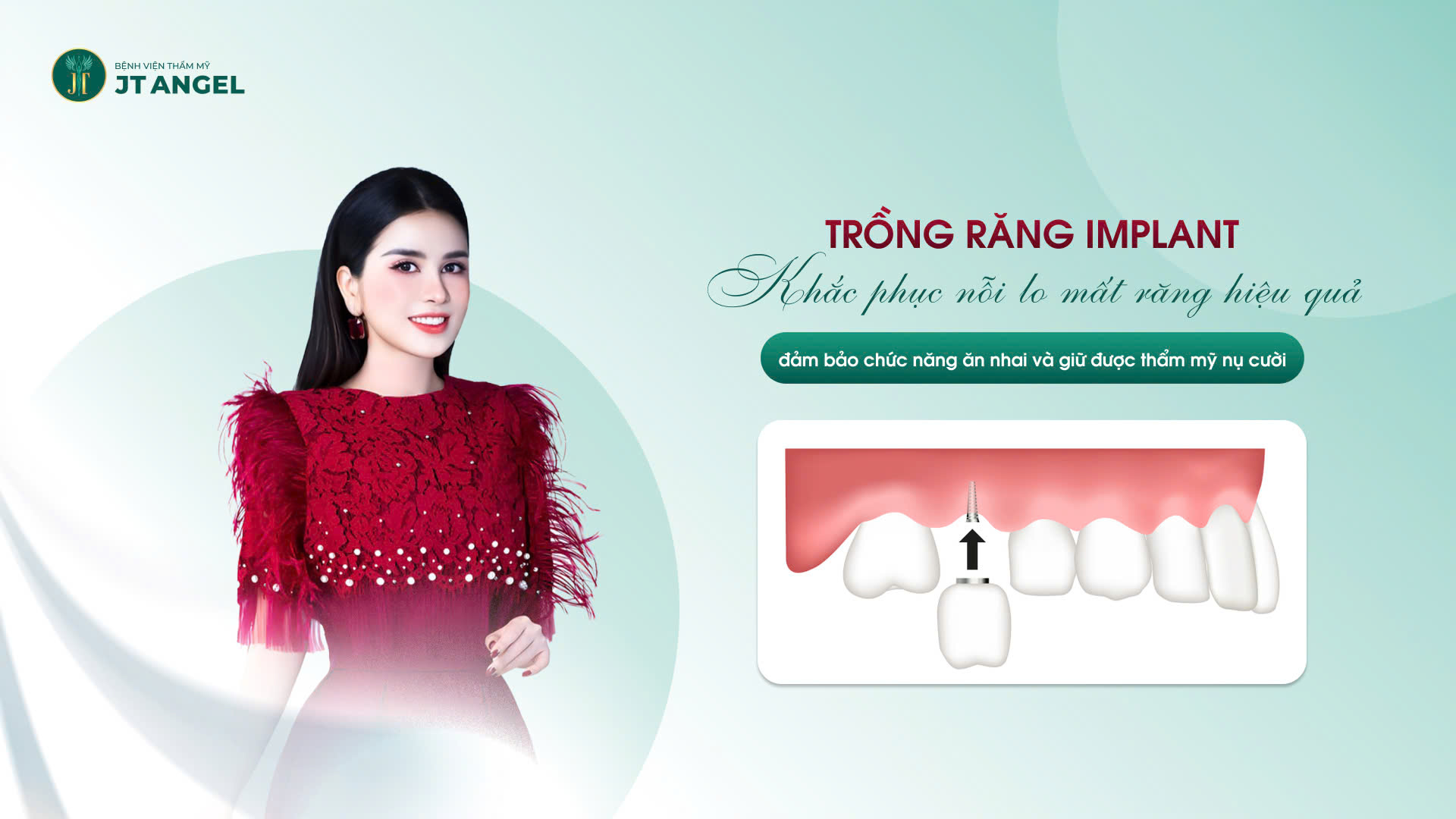 trong-rang-implant-khac-phuc-noi-lo-mat-rang-hieu-qua-dam-bao-chuc-nang-an-nhai-va-giu-duoc-tham-my-nu-cuoi