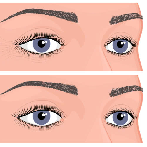 xoa-nhan-duoi-mat-bang-botox-mach-ban-bi-quyet-tre-hoa-nhanh-xoa-nhan-khong-xam-lan-va-giu-mai-net-thanh-xuan