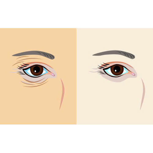 xoa-nhan-duoi-mat-bang-chi-collagen-mach-ban-bi-quyet-tre-hoa-da-vung-mat-khong-can-phau-thuat