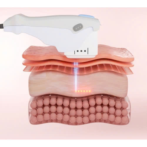 xoa-nhan-duoi-mat-bang-cong-nghe-hifu-bi-quyet-tre-hoa-van-nguoi-me-khong-can-phau-thuat