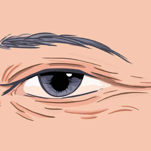 xoa-nhan-duoi-mat-bang-cong-nghe-hifu-bi-quyet-tre-hoa-van-nguoi-me-khong-can-phau-thuat