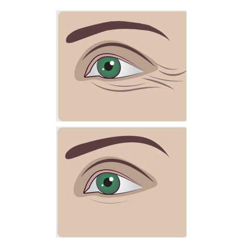 cung-tim-hieu-phuong-phap-xoa-nhan-duoi-mat-bang-laser-la-gi-uu-diem-quy-trinh-va-nhung-ai-phu-hop-voi-phuong-phap-lam-dep-nay