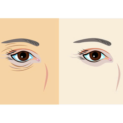 cung-tim-hieu-phuong-phap-xoa-nhan-duoi-mat-bang-laser-la-gi-uu-diem-quy-trinh-va-nhung-ai-phu-hop-voi-phuong-phap-lam-dep-nay