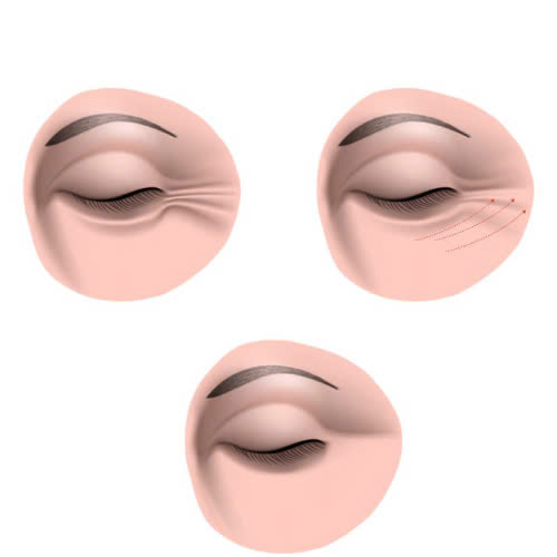 xoa-nhan-duoi-mat-co-thay-doi-tuong-so-khong-su-that-bat-ngo-ban-nen-biet-truoc-khi-quyet-dinh-thuc-hien