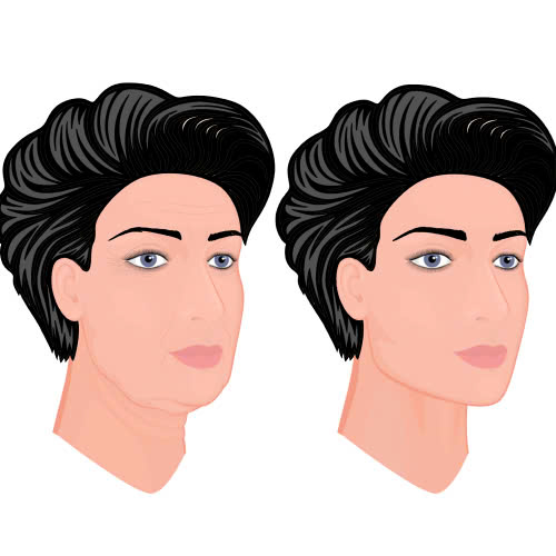 xoa-nhan-duoi-mat-gia-bao-nhieu-giai-dap-chi-tiet-nhung-phuong-phap-pho-bien-hien-nay