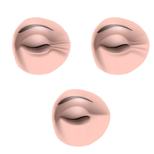 xoa-nhan-duoi-mat-gia-bao-nhieu-giai-dap-chi-tiet-nhung-phuong-phap-pho-bien-hien-nay