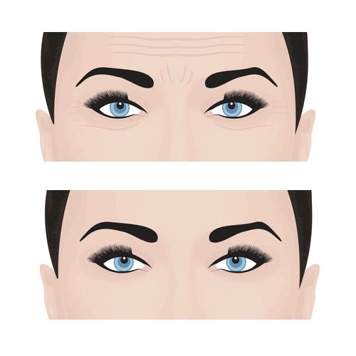 xoa-nhan-duoi-mat-khong-phau-thuat-giai-phap-tre-hoa-tu-nhien-it-xam-lan-khong-can-dao-keo