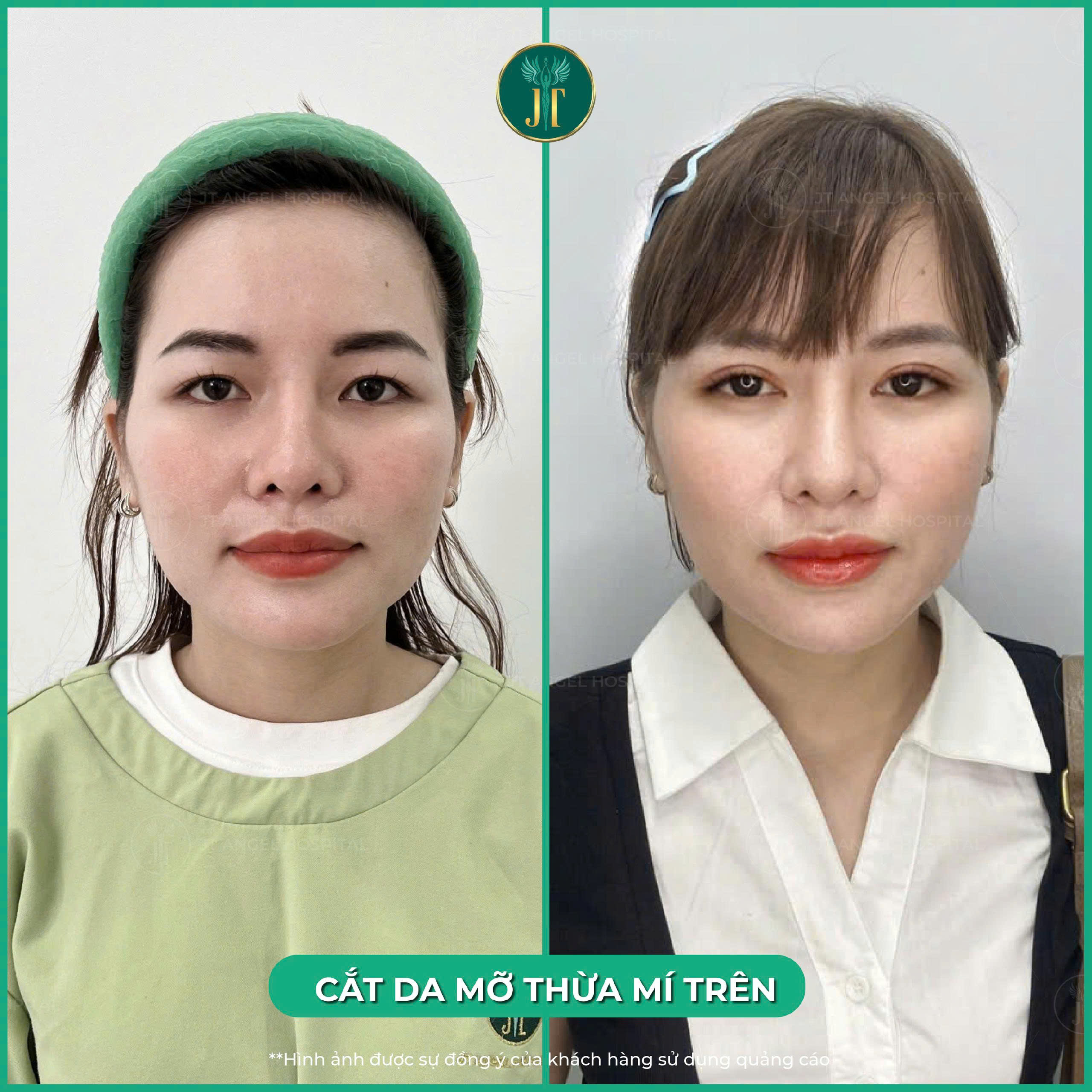 hinh-anh-truoc-sau-lay-mo-mi-tren-bat-ngo-voi-su-thay-doi-tre-hoa-doi-mat-chi-sau-1-lan-khien-hoi-chi-em-phai-xuyt-xoa