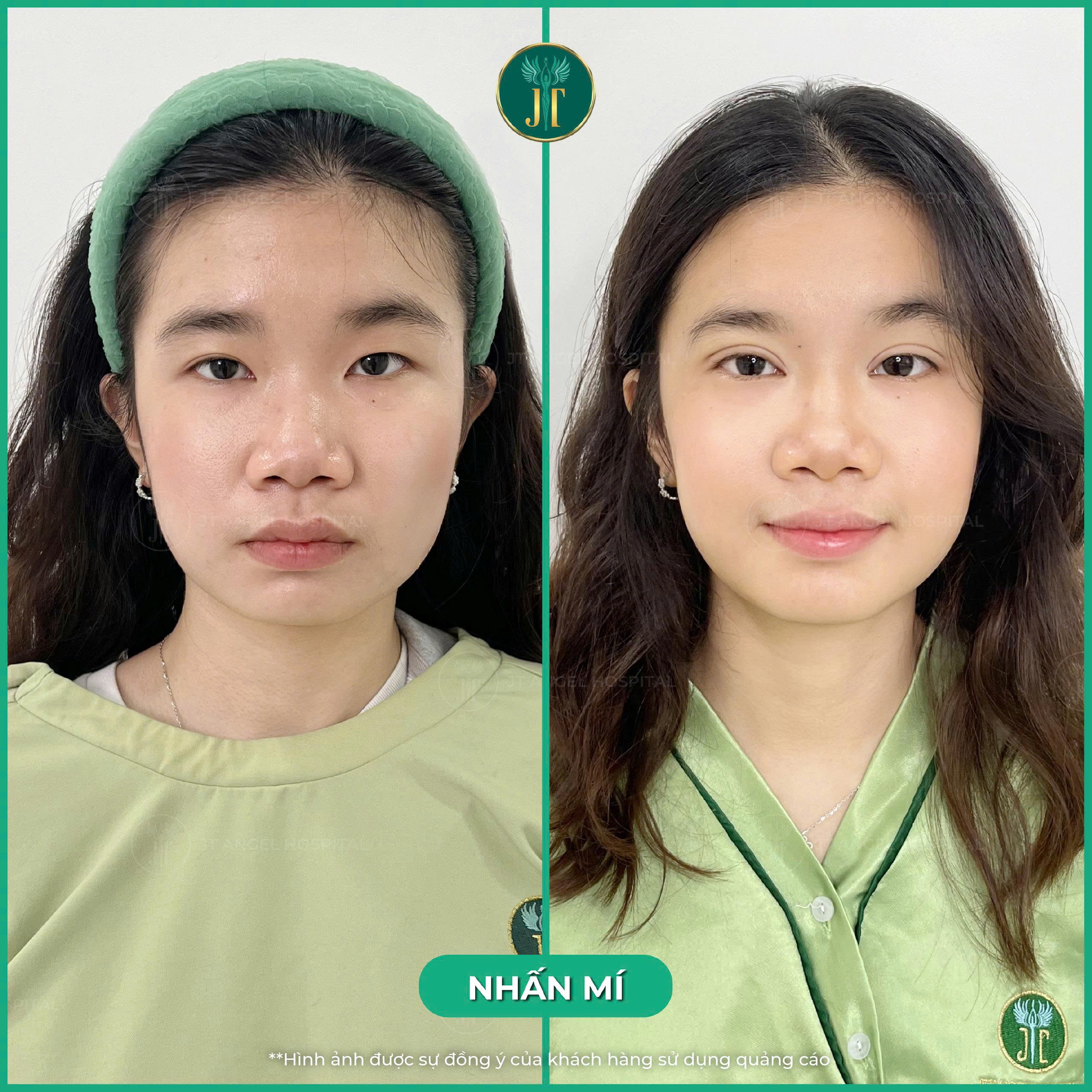 hinh-anh-truoc-sau-nhan-mi-bi-mat-dang-sau-doi-mat-2-mi-dep-tu-nhien