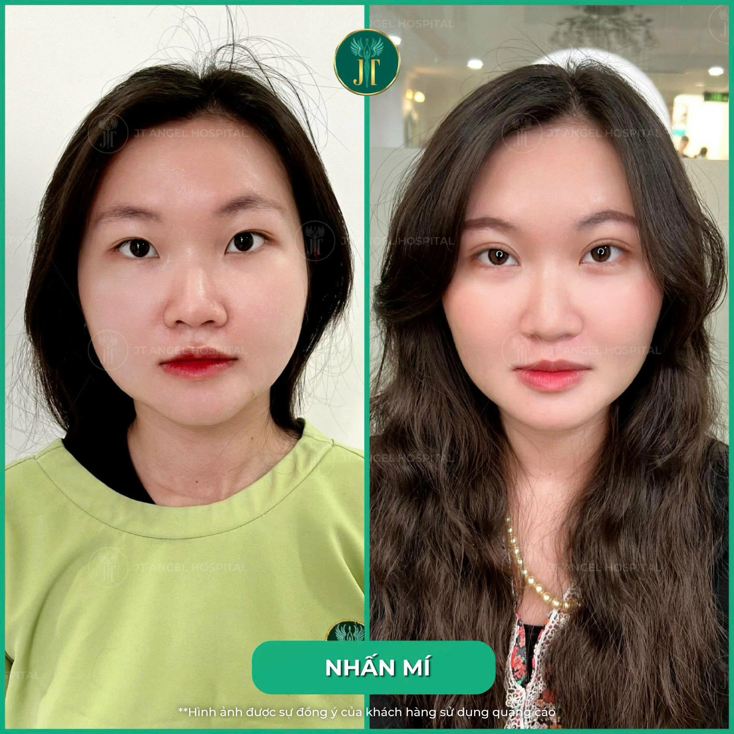 hinh-anh-truoc-sau-nhan-mi-bi-mat-dang-sau-doi-mat-2-mi-dep-tu-nhien