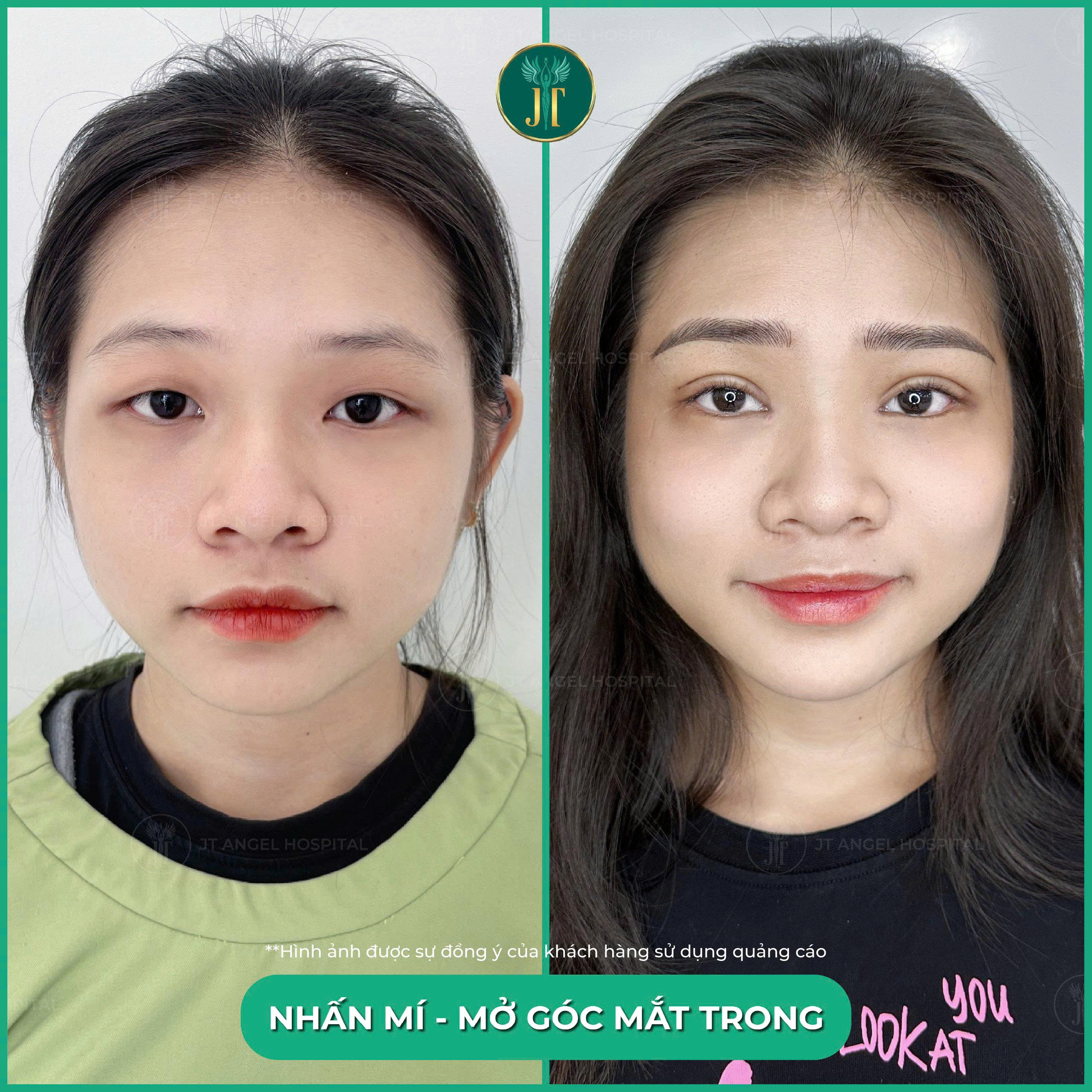 hinh-anh-truoc-sau-nhan-mi-bi-mat-dang-sau-doi-mat-2-mi-dep-tu-nhien