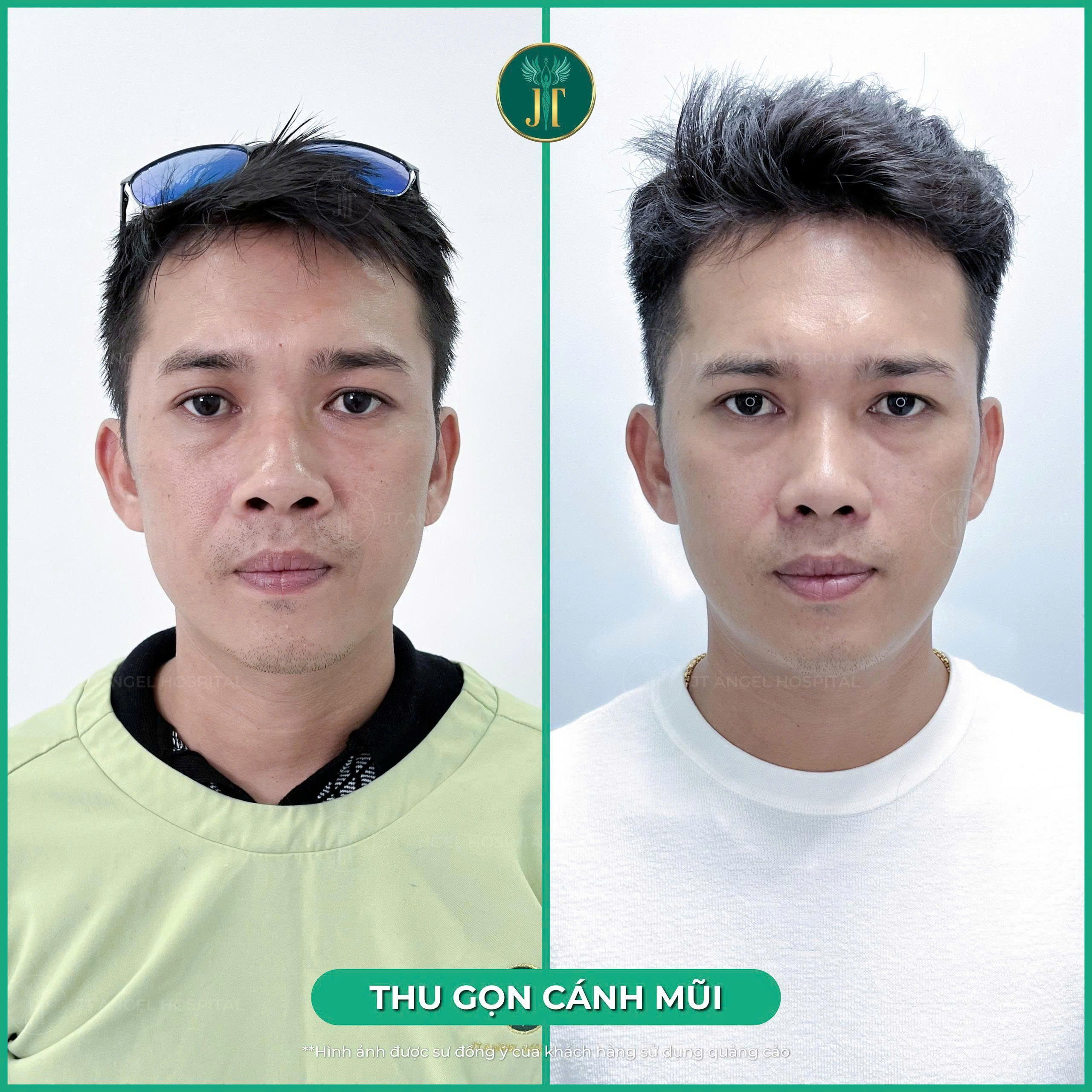 hinh-anh-truoc-va-sau-thu-gon-canh-mui-bien-hoa-ngoai-hinh-that-tuyet-voi