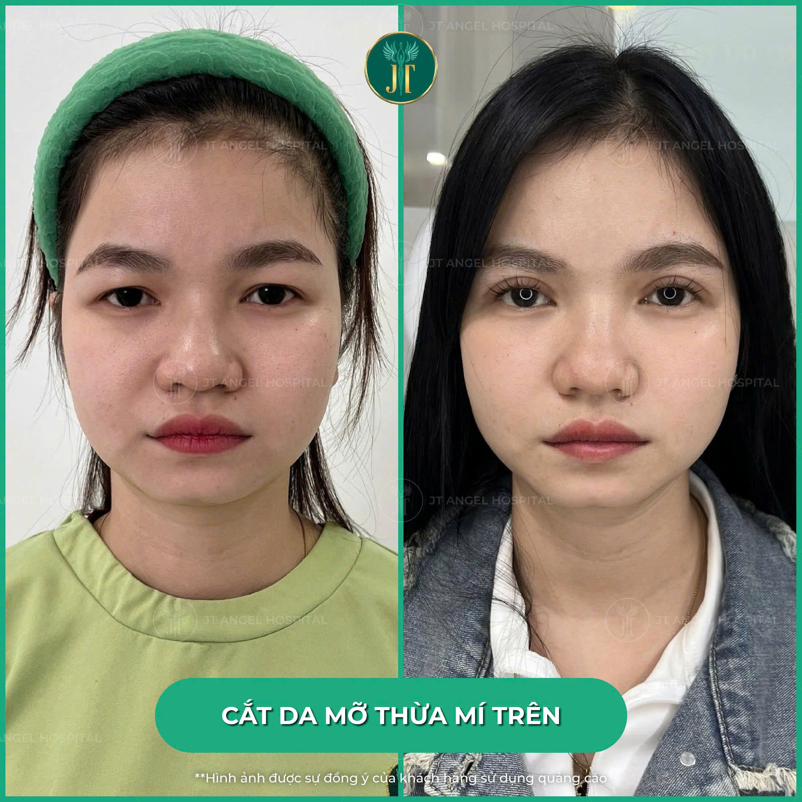 lay-mo-mi-tren-bi-sung-bao-lau-top-5-bi-quyet-giup-ban-hoi-phuc-on-dinh-nhanh-hon-mong-doi