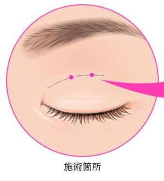 nhan-mi-bi-bung-chi-xu-ly-chuan-de-tranh-bien-chung