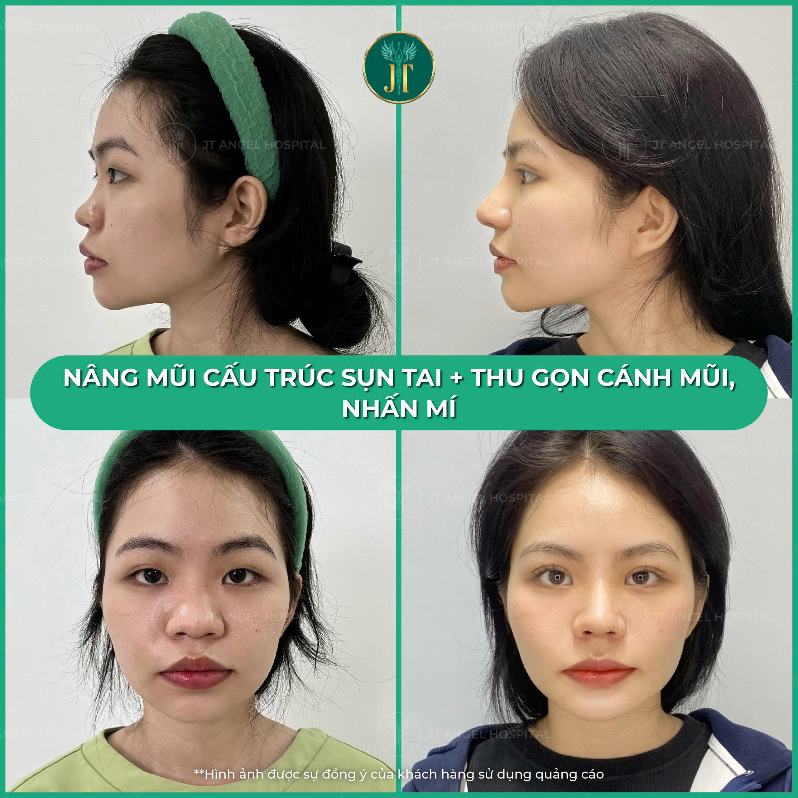 giai-dap-moi-thac-mac-thu-gon-canh-mui-co-dau-khong-va-loi-ich-dot-pha-cua-phau-thuat-tham-my